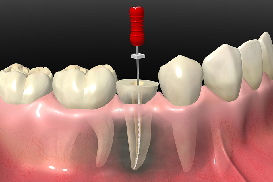 根管治療の重要性