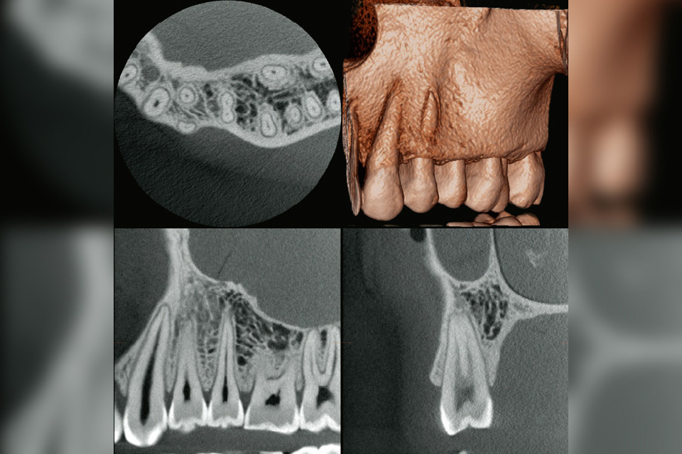 歯科用CTの使用